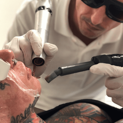 Eliminación de Tatuajes en Clínica Tufet Barcelona con @queteloquiteluis2.0