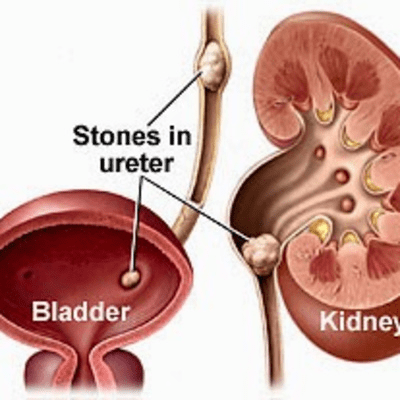 episode KIDNEY STONE - 'causes, symptoms, diagnosis, treatment, pathology' artwork