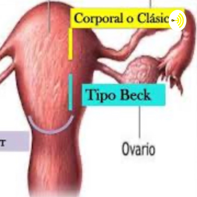 Cesárea tipo Beck