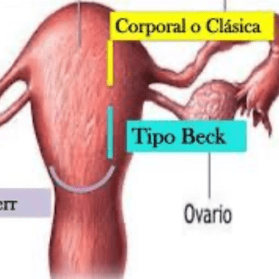 episode Cesárea tipo Beck artwork