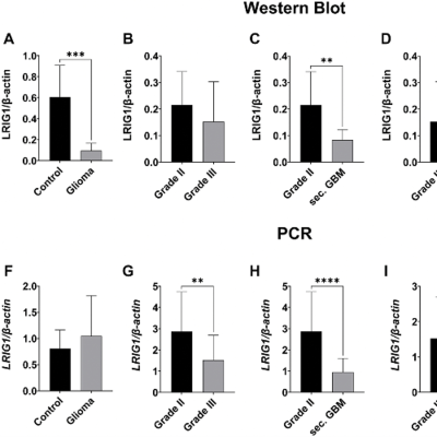 episode Lower LRIG1 Expression Linked to Aggressive Gliomas artwork