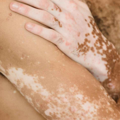 episode Allt om fläckar; Vitiligo, Guttat Hypomelanos och Melanom artwork