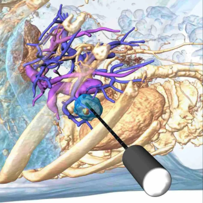 episode A complete package for minimally invasive tumor therapy artwork