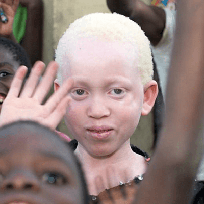 episode Albinos en África en grave peligro - Mariana Gómez Vieira artwork