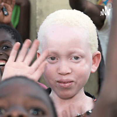 Mariana Gómez y la problemática de los albinos en África.