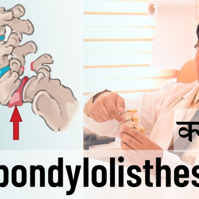 episode Spondylolisthesis क्या होता है ? What is Spondylolisthesis? Complete Info in Hindi - By Dr Hitesh Garg artwork