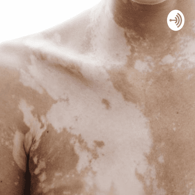 Let’s talk Vitiligo