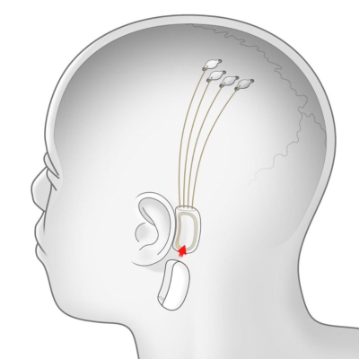 episode Neuralink Progress Update — Summer 2020 artwork