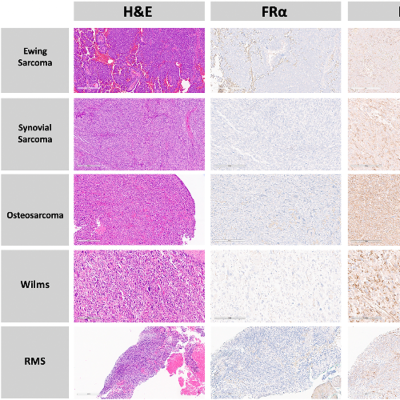 episode Folate Receptor Beta Found in Pediatric Tumors May Improve Fluorescence-Guided Cancer Surgery artwork