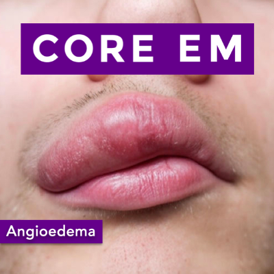 episode Episode 212: Angioedema artwork