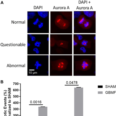 episode New Radiofrequency Therapy Slows Glioblastoma Growth and Targets Tumor Stem Cells artwork