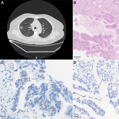 episode HER2-Mutated NSCLC in Brazil Shows Diverse Genetic Patterns and Treatment Gaps artwork